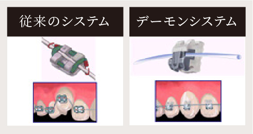 従来の矯正システムとの比較