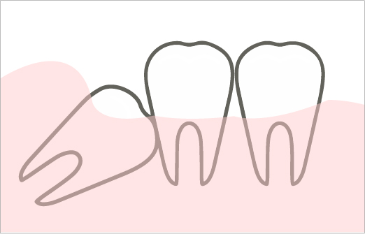 親知らずの抜歯・難抜歯