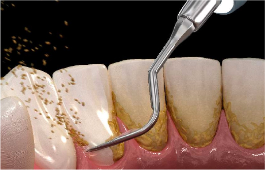 歯石除去（スケーリング）
                
