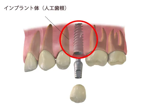 インプラント埋入