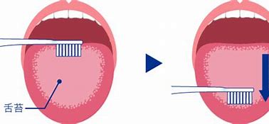 【舌磨き｜口臭の原因を除去】
