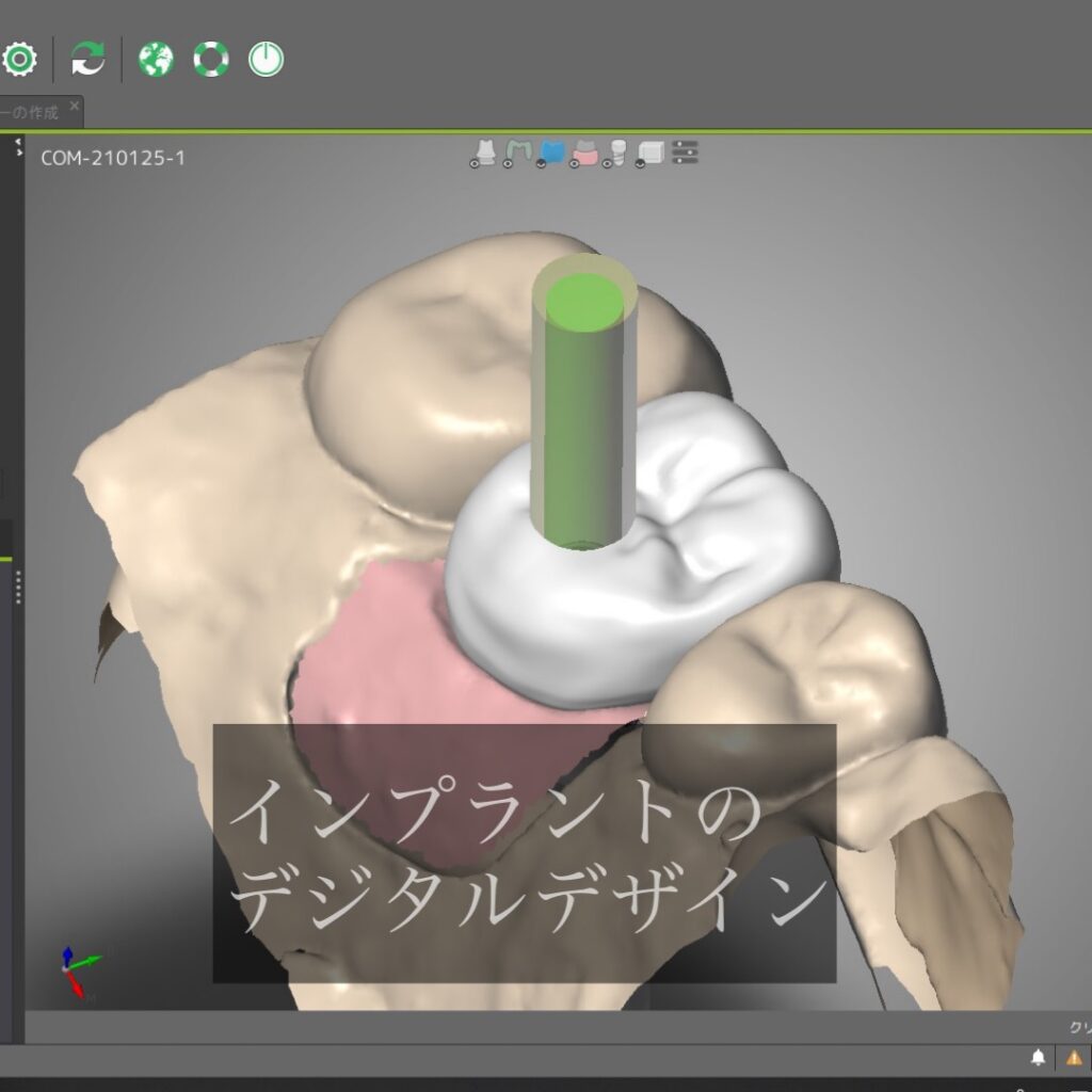 インプラントのデジタルデザイン2021125