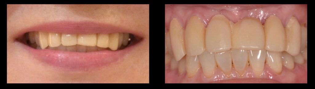 仮歯の形がおかしい セラミック治療例 50代女性 東京赤坂ヴィーナスデンタル