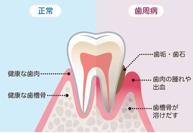 歯周病について　2023.1.19