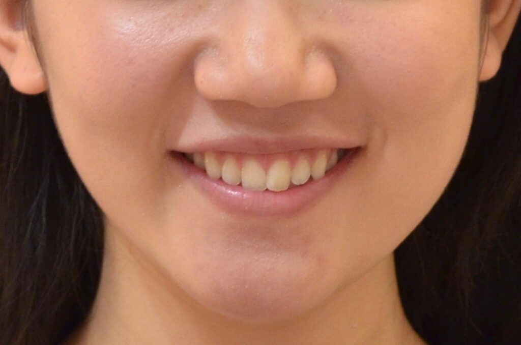 気づかれずに歯並びを治したい。【マウスピース矯正治療例】20代女性　n877.20170426