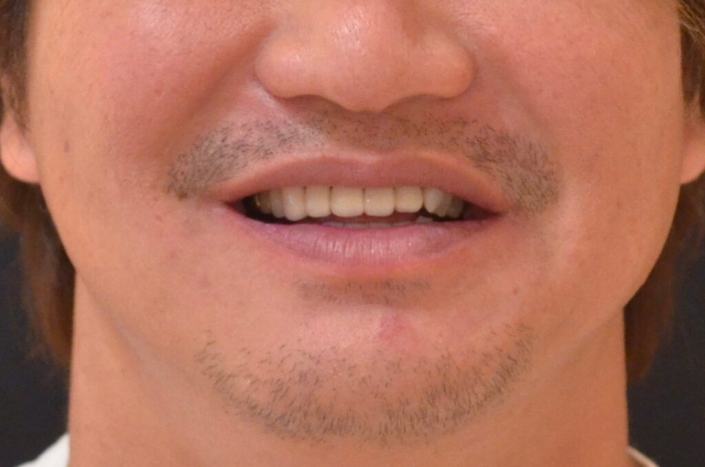 他院でのセラミックを治したい。【セラミック治療例】50代男性　k1475.20220907