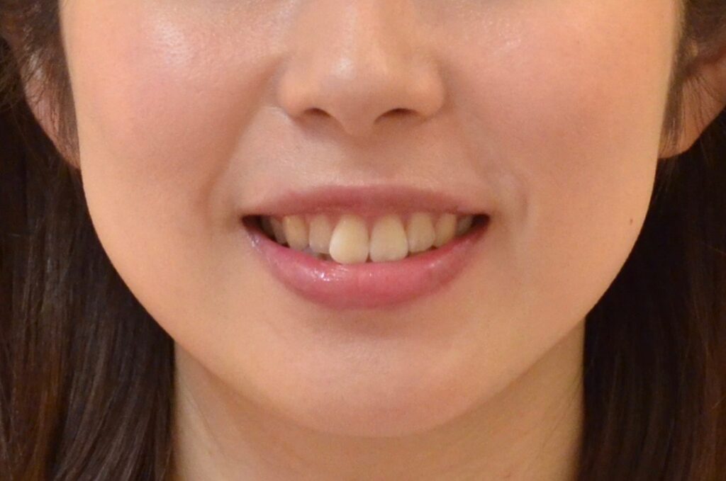 出っ歯を治したい。【ワイヤー矯正治療例】20代女性　m1791.20210512