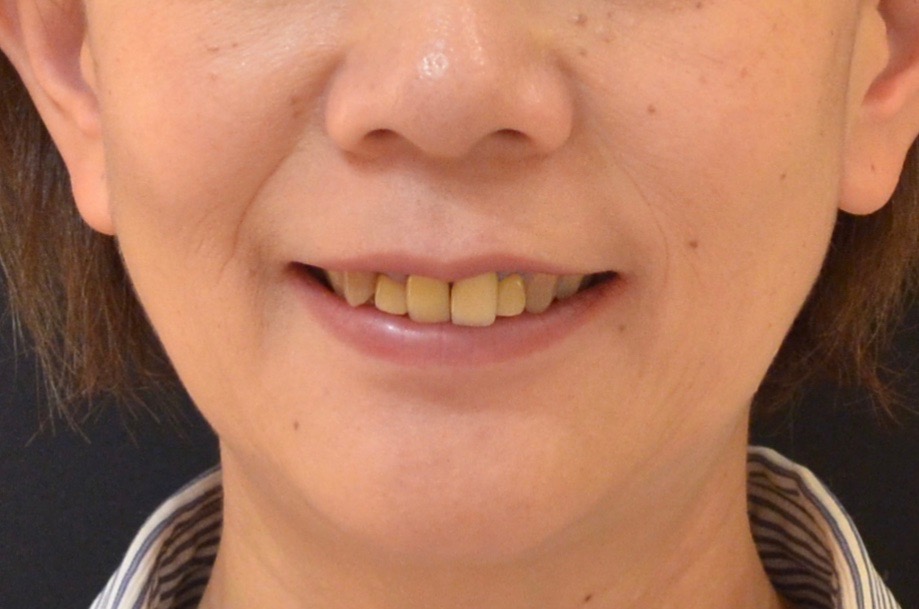 虫歯と歯並びを治したい。【矯正治療・セラミック治療例】50代女性　k915.20170620