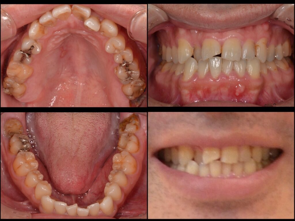 歯並びを治したい　40代男性　2023.9.19