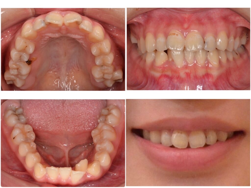 歯並びが気になる　20代女性　2023.11.8