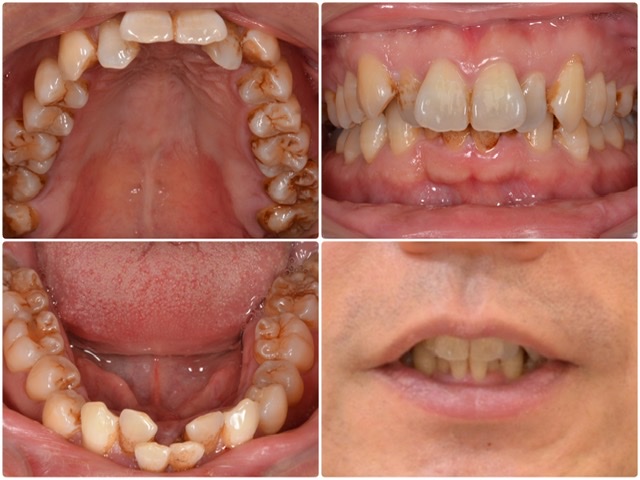 歯並び（叢生）の矯正と着色除去　2024.2.8