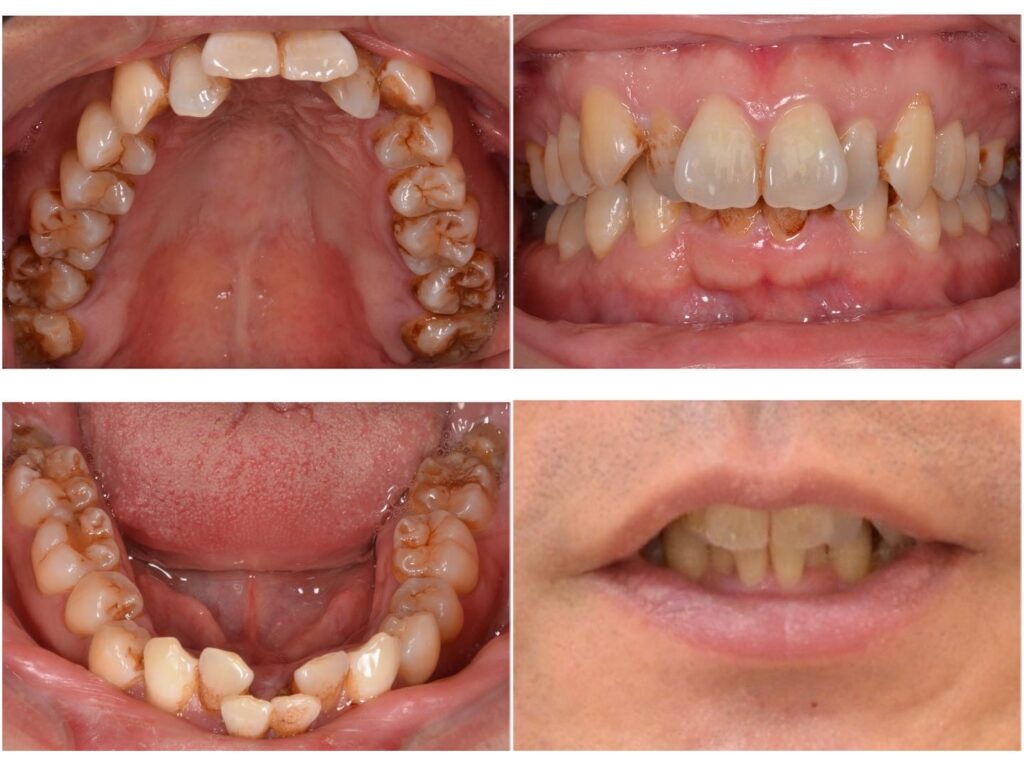 歯並びを矯正したい　50代男性　2024.4.16