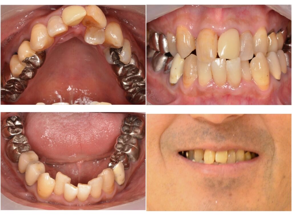 歯並びを改善したい　50代男性　2024.4.9