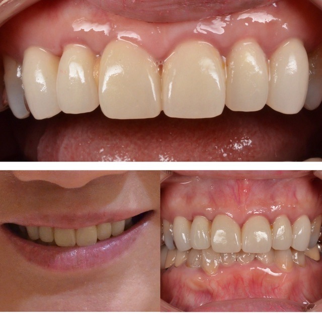 前歯に納得のいくセラミックを入れたい　50代女性　2025.10.30
