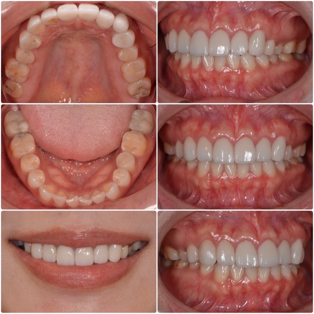 セラミックをやり直したい2025.10.31